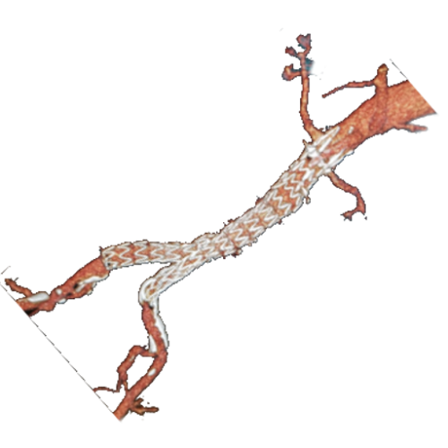 Aneurysm Repair (Open + Minimally Invasive)