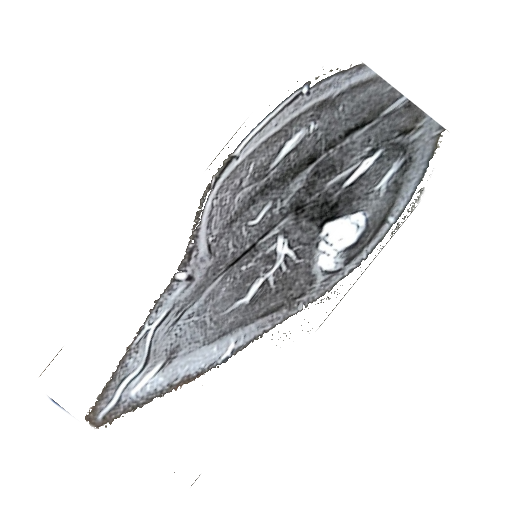 Arteriovenous Malformation