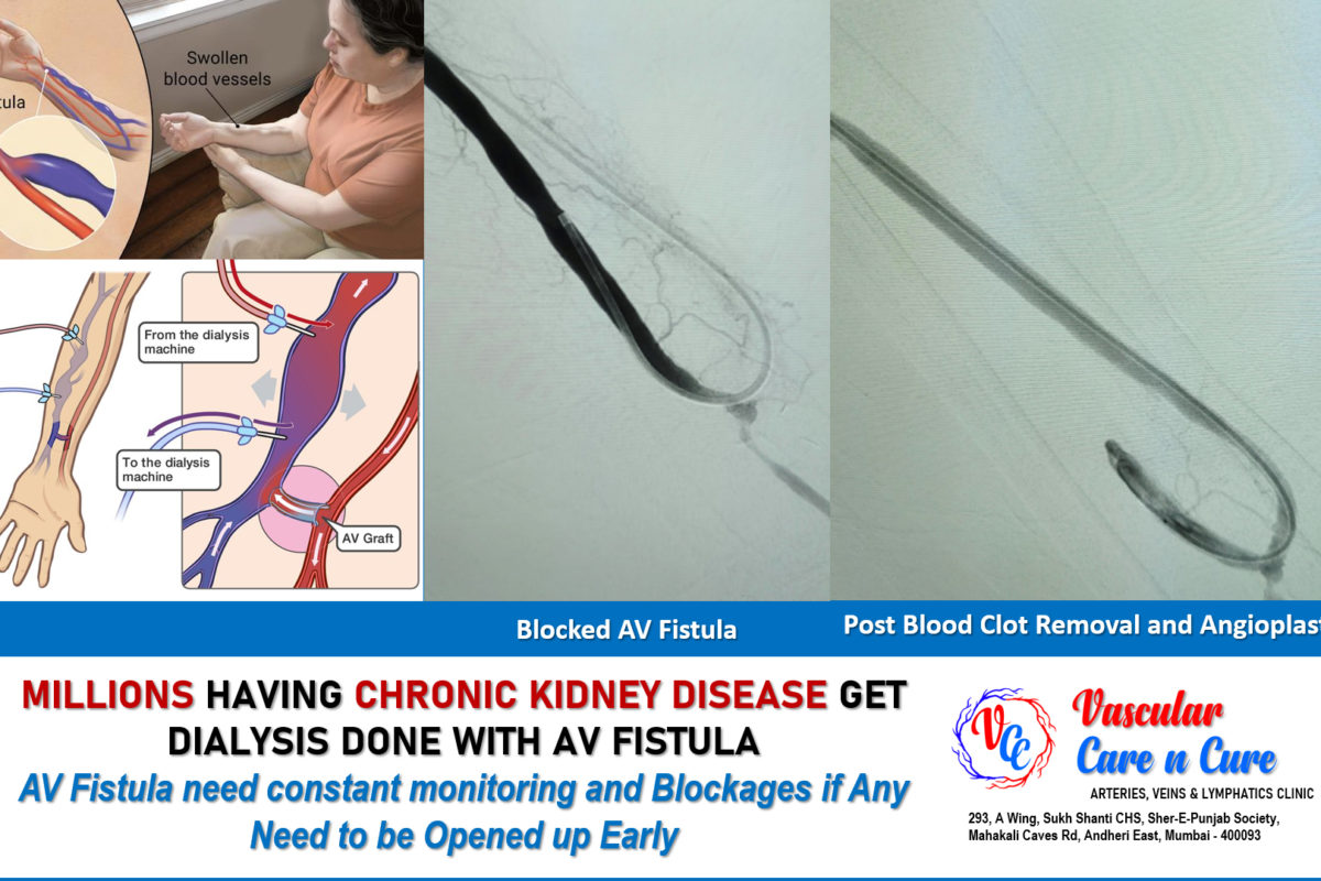 Arteriovenous Fistula – Facts