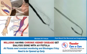 Arteriovenous Fistula – Facts
