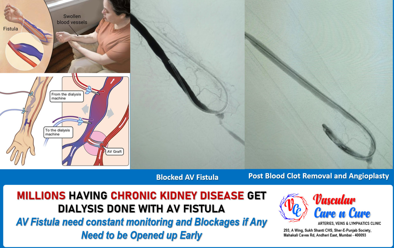 Arteriovenous Fistula – Facts