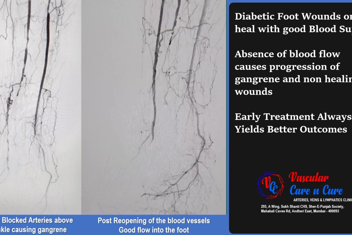 Concept of Angiosome and the ISSUE WITH MULTIPLE COOKS (Specialists)