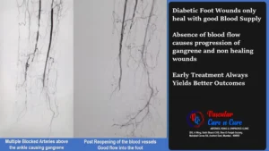 Concept of Angiosome and the ISSUE WITH MULTIPLE COOKS (Specialists)