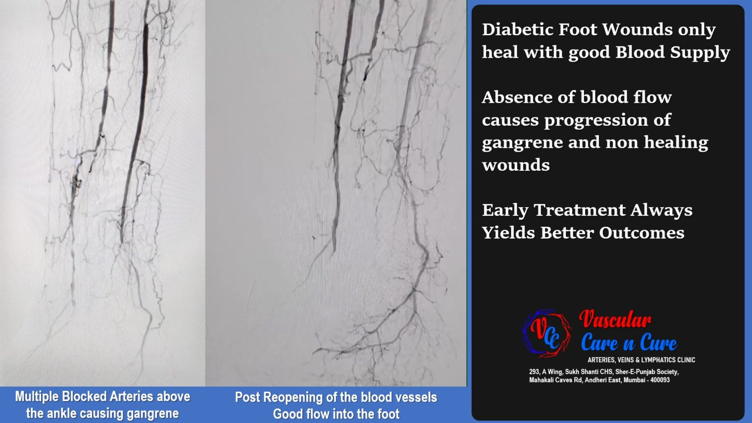 Concept of Angiosome and the ISSUE WITH MULTIPLE COOKS (Specialists)