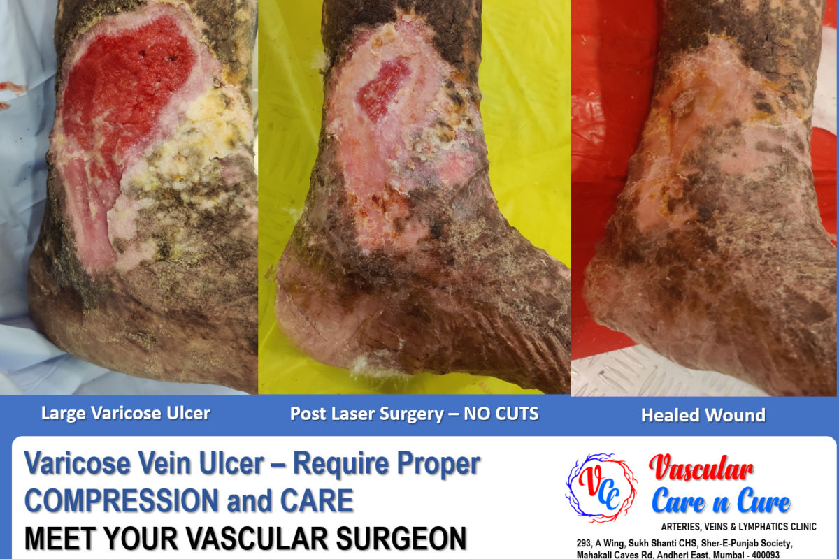 Healed varicose veins ulcer