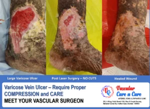 Healed varicose veins ulcer