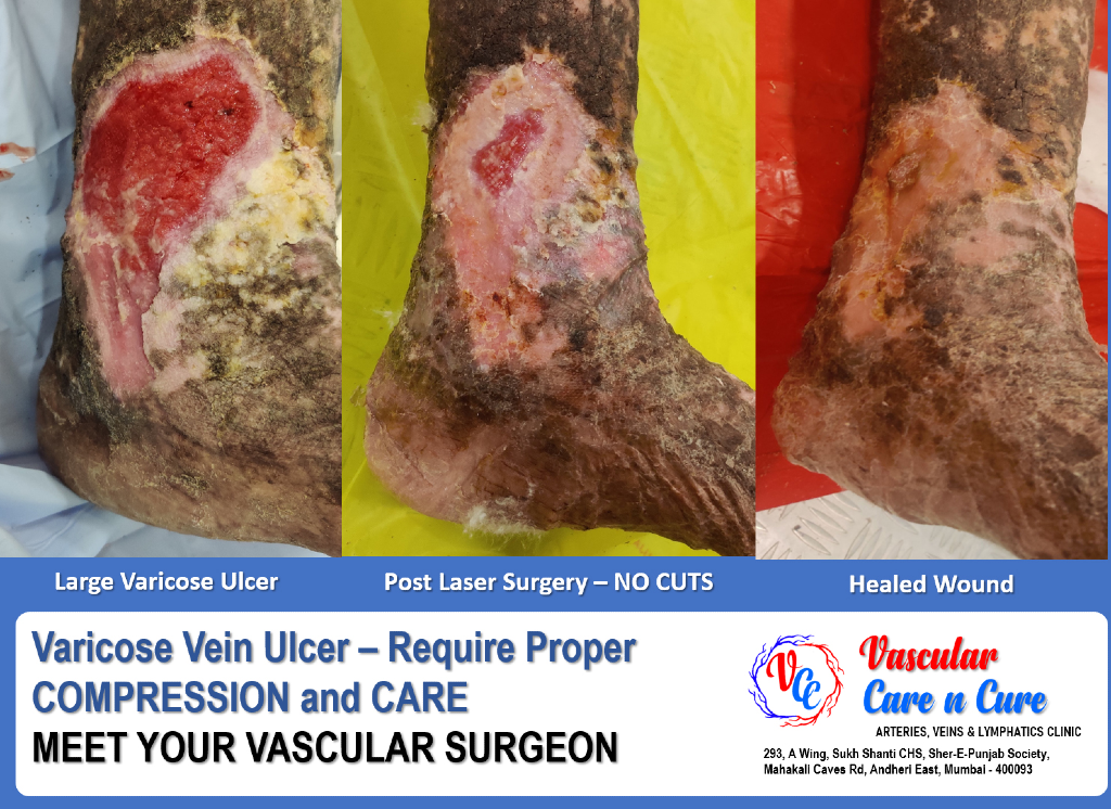 Healed varicose veins ulcer