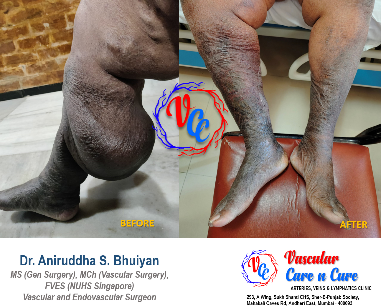 Lymphovenous Disorders