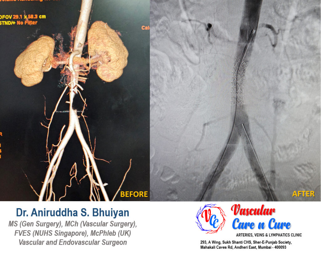 Stenting outside the heart