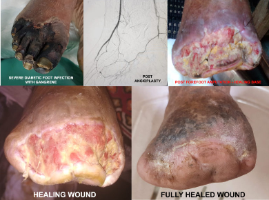 Peripheral Vascular Disease and Diabetic Foot