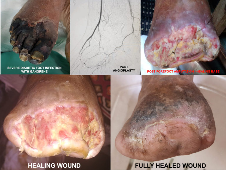 Peripheral Vascular Disease