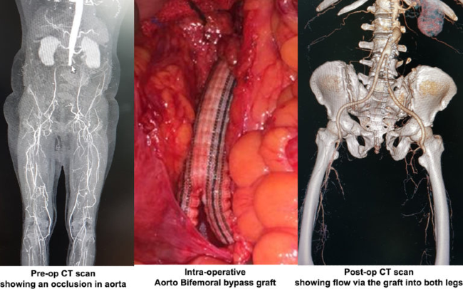 Aortoiliac Occlusion