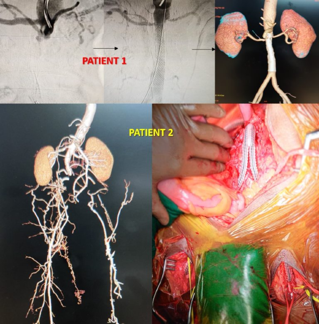 Aortoiliac Occlusion