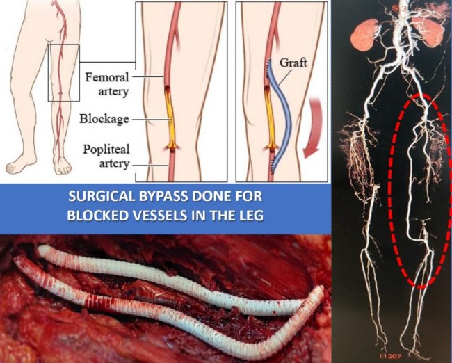 Surgical Bypass
