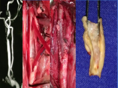 Carotid Artery Disease (Stroke Surgery)