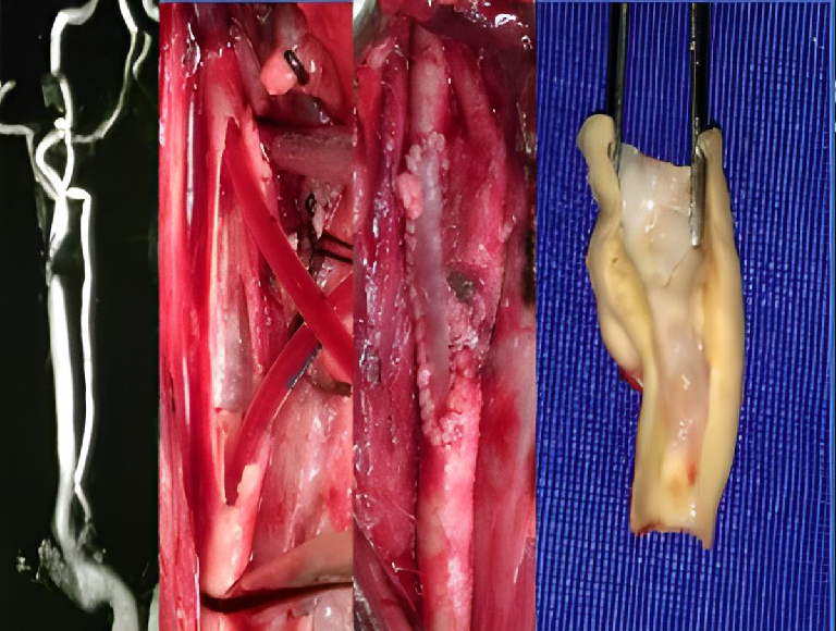 Carotid Artery Disease