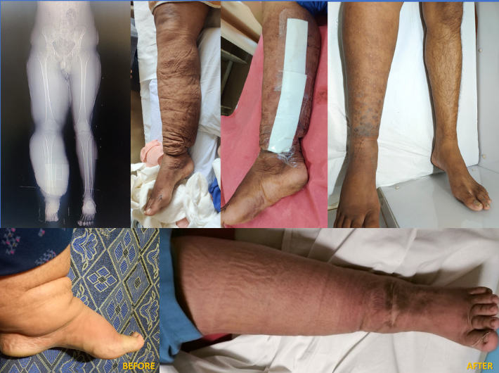 Lymphedema