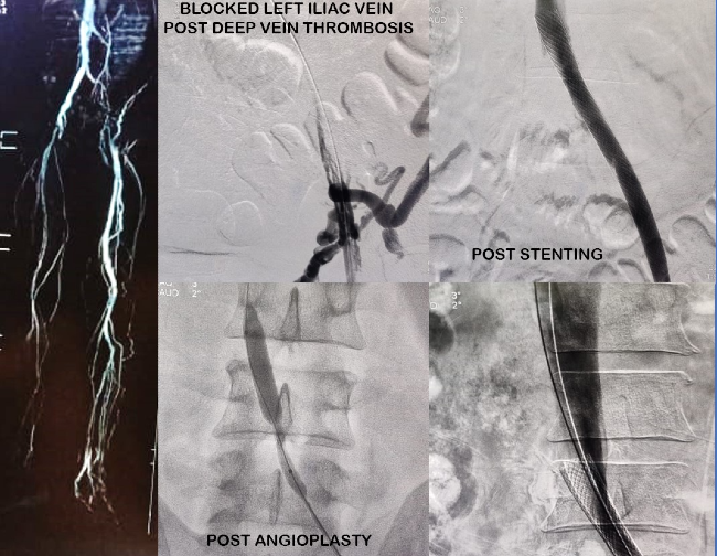 Venogram of a blocked left iliac vein after deep vein thrombosis, after angioplasty and after stenting