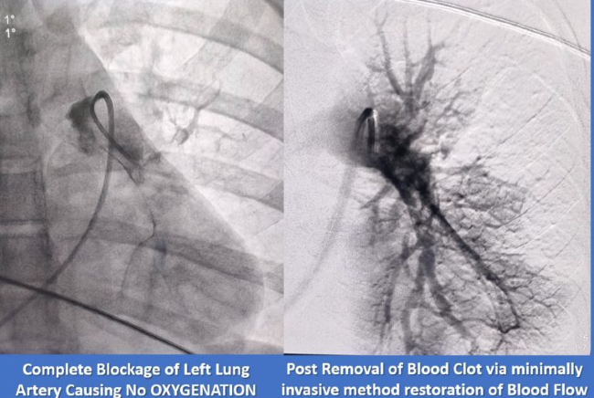 Pulmonary Embolism (PE)