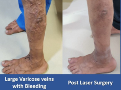 Varicose Veins