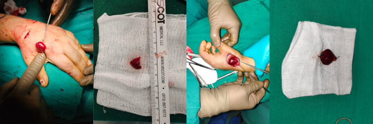 Vascular Malformations