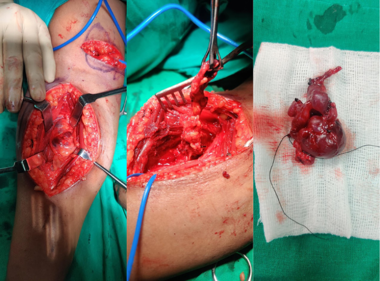 Vascular Malformations