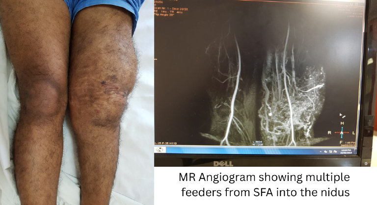 Vascular Malformations