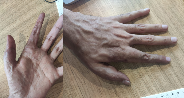 Vascular Malformations