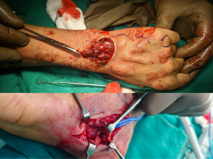 Vascular Malformations