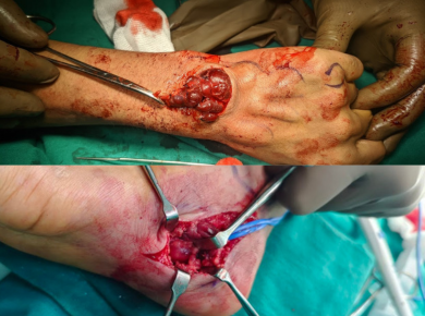 Vascular Malformations