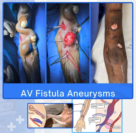 Dialysis Access AVF, AVG and Permcaths