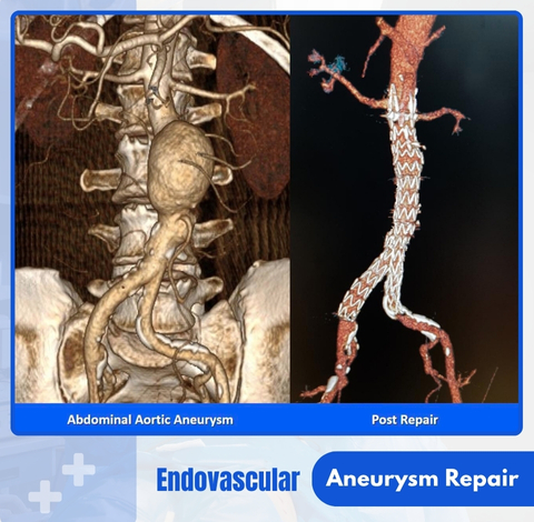 Aortic Aneurysms