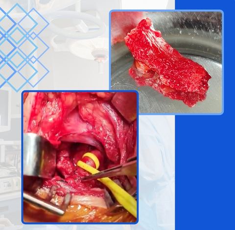 Thoracic Outlet And Cervical Rib