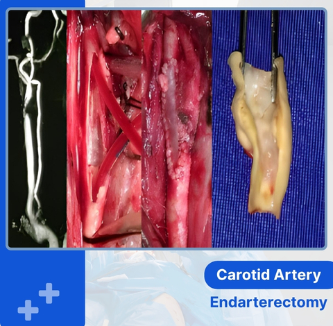 Carotid Artery Disease