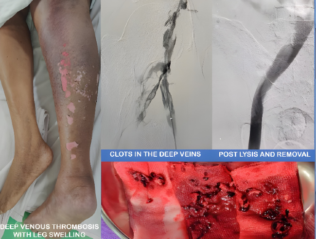 Deep Vein Thrombosis
