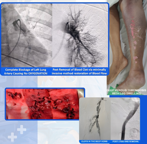 DVT and PE