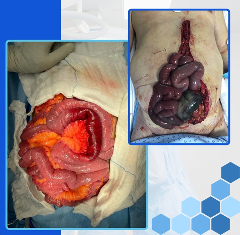 Mesenteric / Bowel Ischaemia