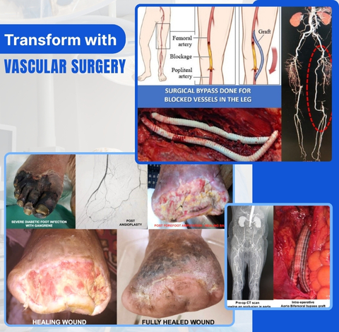 Peripheral Arterial Disease And Diabetic Foot