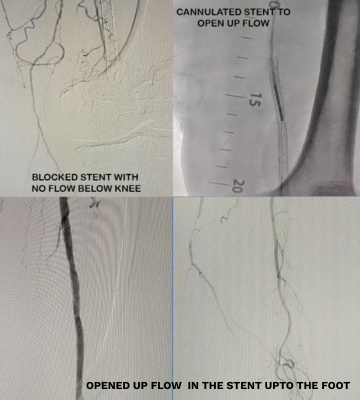 Peripheral Arterial Disease And Diabetic Foot