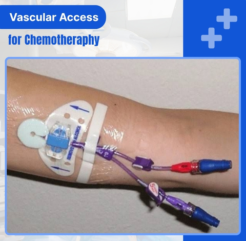 Vascular Access for Chemotherapy