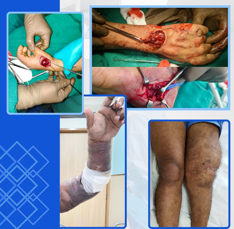 Vascular Malformation