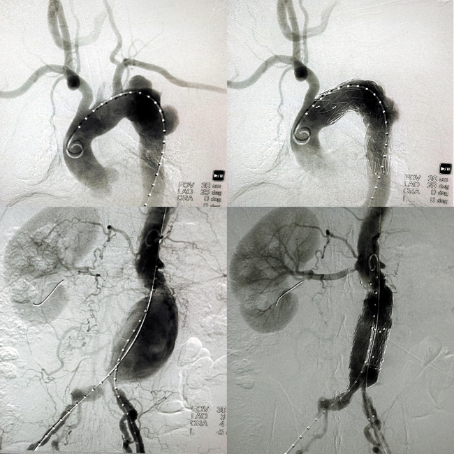 Aortic Aneurysms