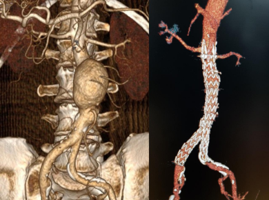 Aortic aneurysms