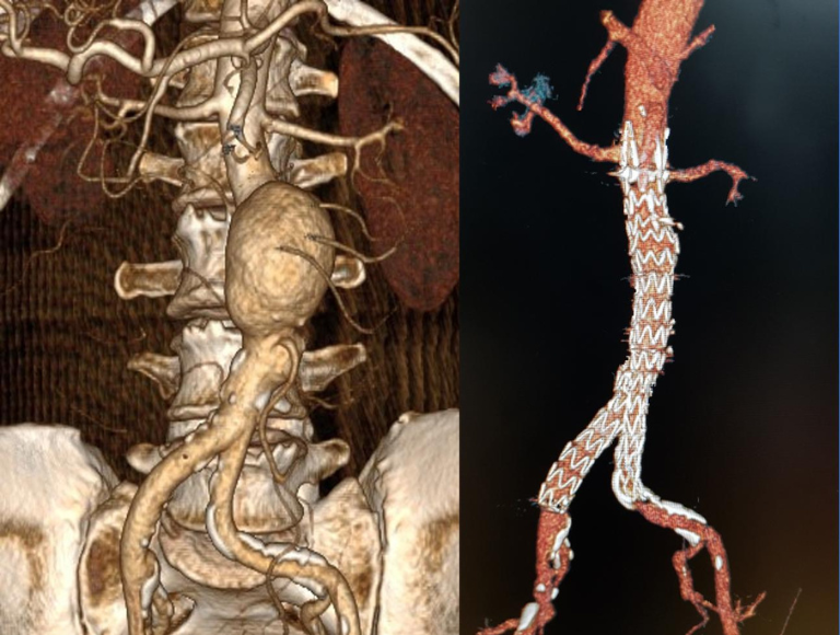 Aortic Aneurysms