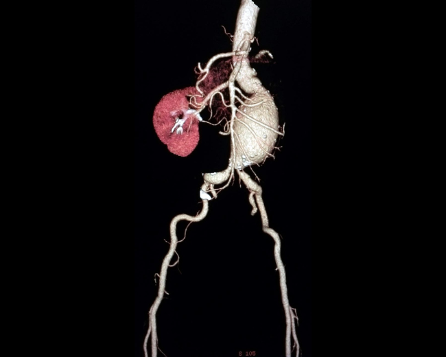 Aortic Aneurysms