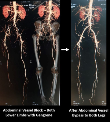 Aorto-femoral bypass