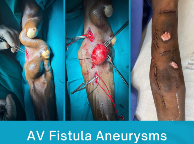 Dialysis Access (AV Fistula, Permacath, AV Grafts)