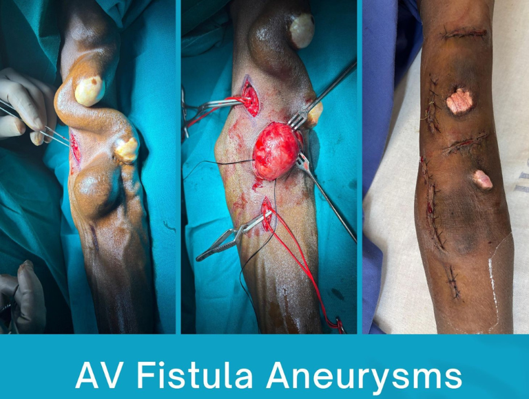 AV Fistula Aneurysms