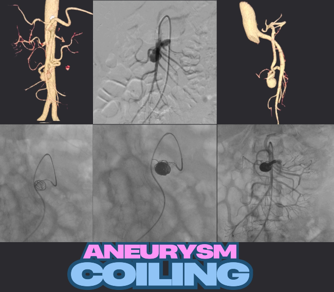 Aneurysms coiling