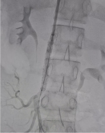 Angiogram after embolisation showing no further flow into the aneurysm